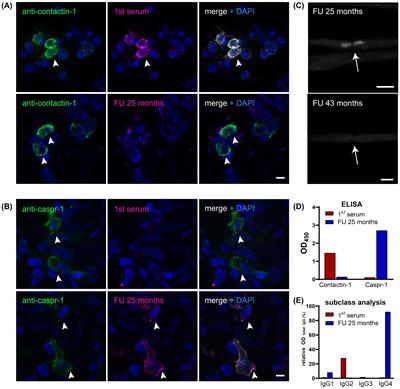 Case report: target antigen and subclass switch in a patient with autoimmune nodopathy